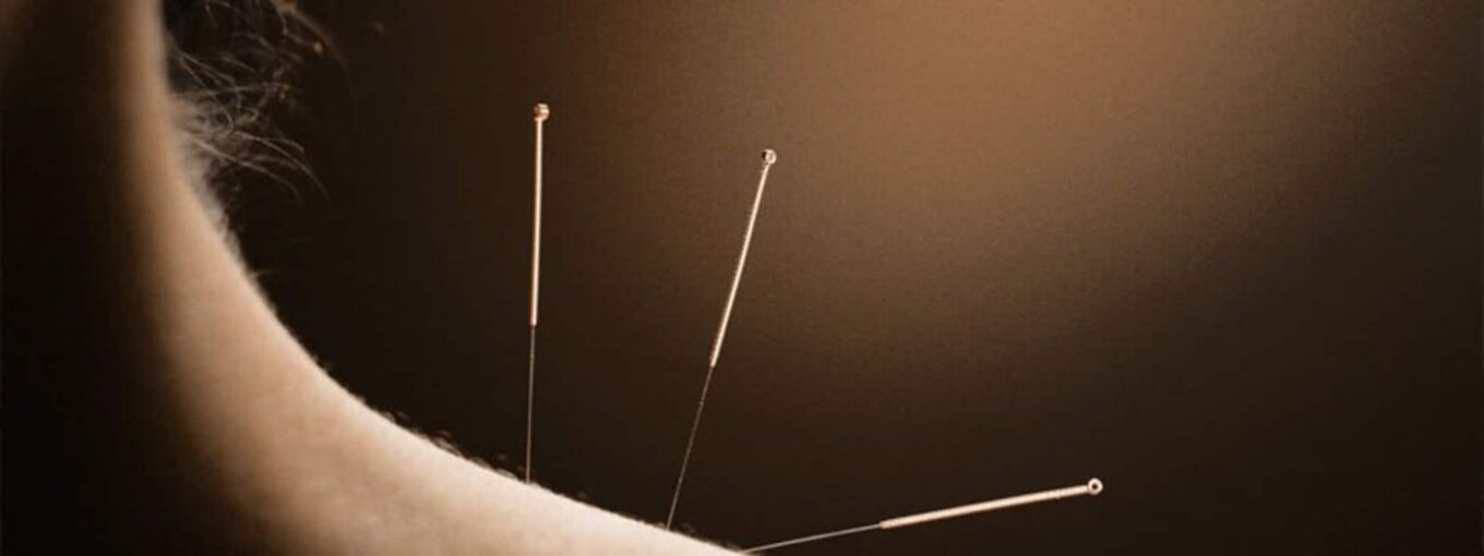 Tratamiento de acupuntura en Biospais, Mataró